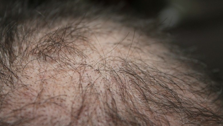 5 Proven Ways to Reverse Hair Loss
