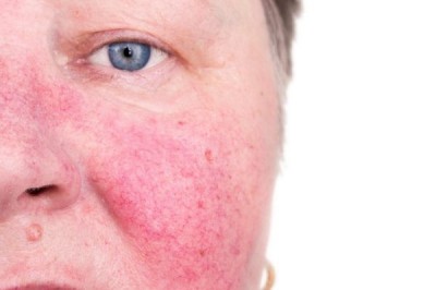 Is Rosacea Treatment Covered by Health Insurance Plans?