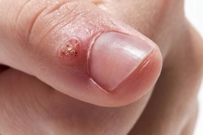 How Can You Speed Up Recovery After Warts Removal?